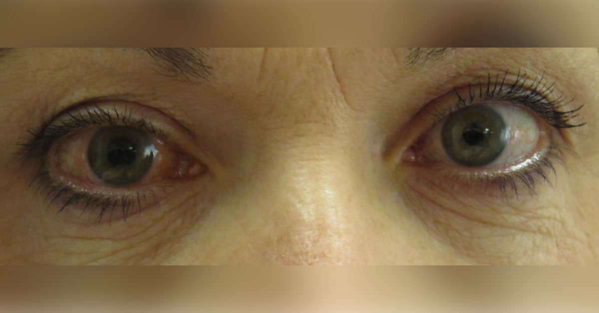 Brief Review On Ocular Manifestations Of Turner's Syndrome