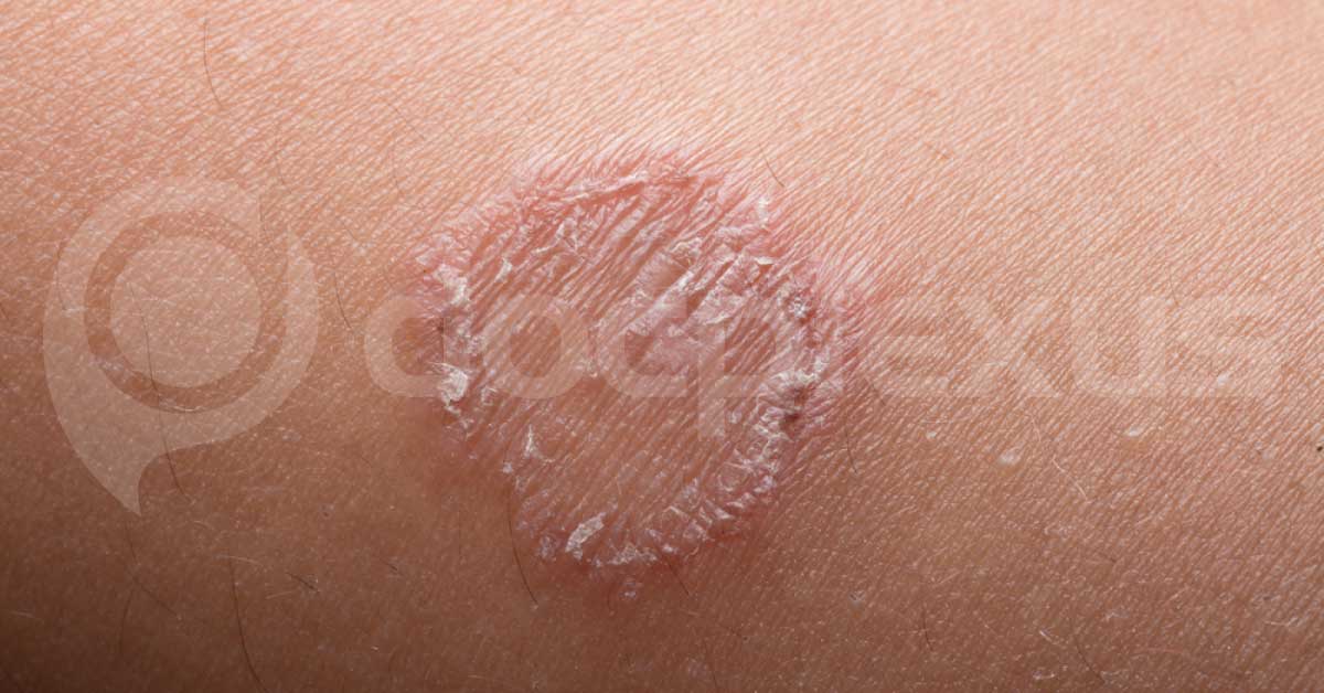 Dermatophytosis, Use Of Systemic Antifungals