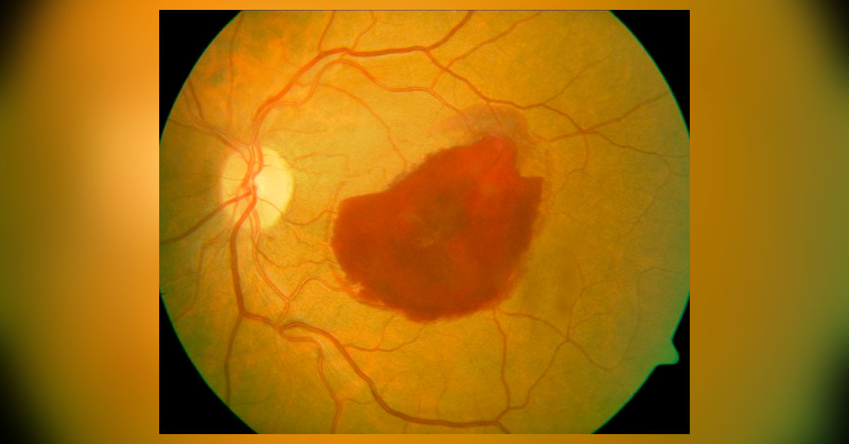 Ocular Manifestations Of Leptospiriosis