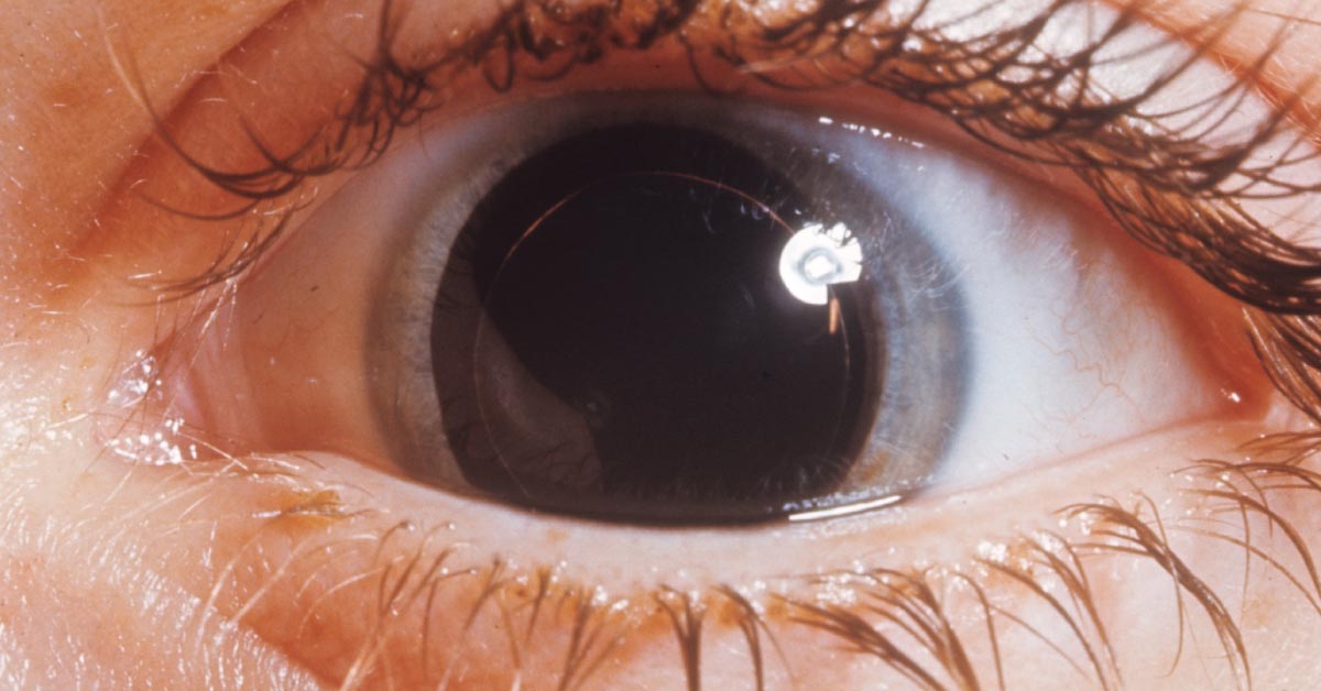 Ocular Manifestations Of Marchesani Syndrome