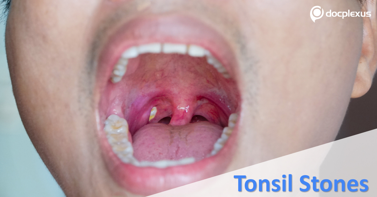 Overview Of Tonsil Stones Or Tonsilloliths
