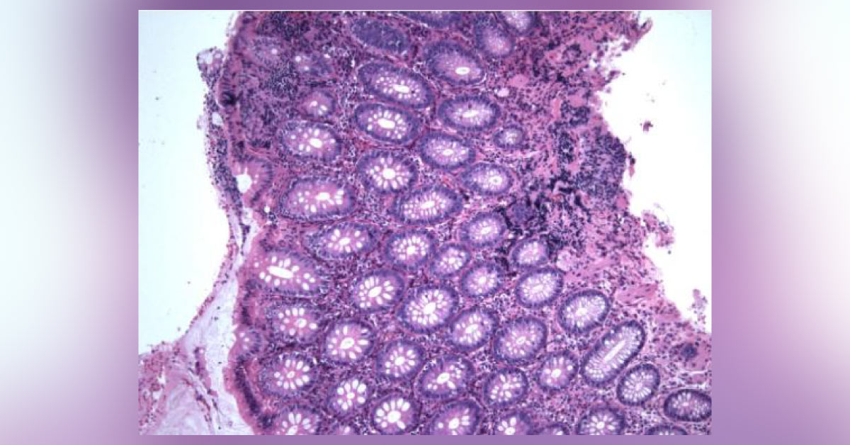 Identify The Reason For Chronic Diarrhea
