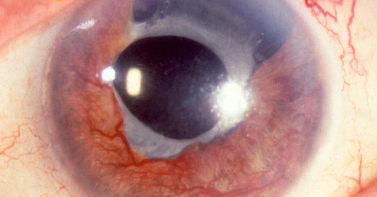 Brief Review On Ocular Manifestations Of Neovascular Glaucoma