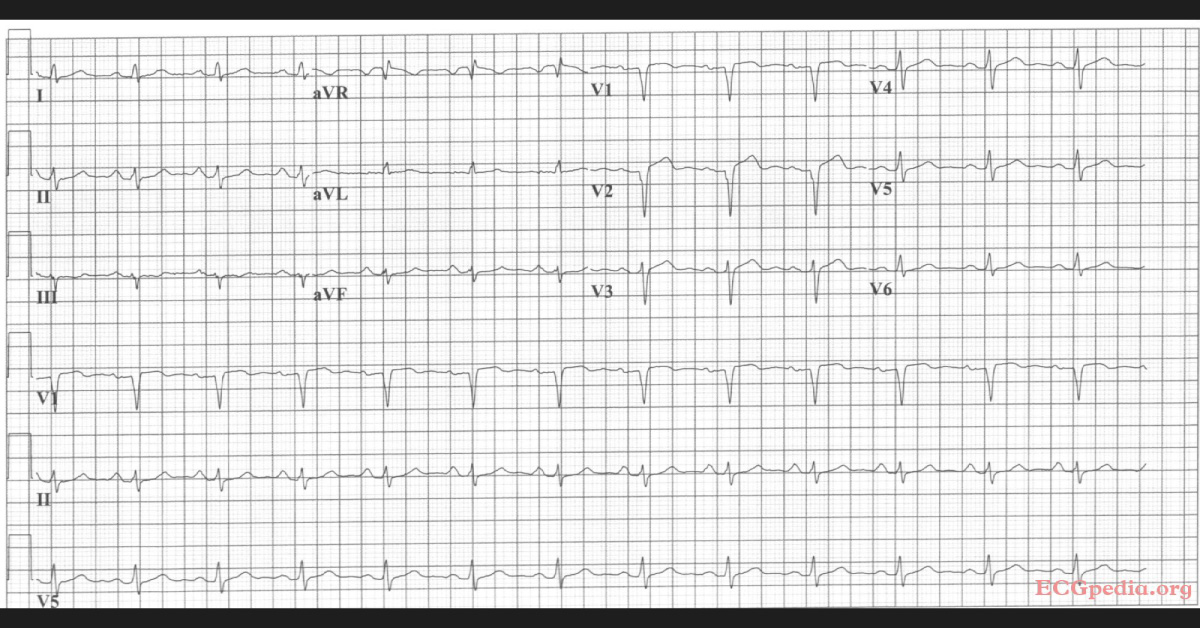 Locate The Myocardial Infarction