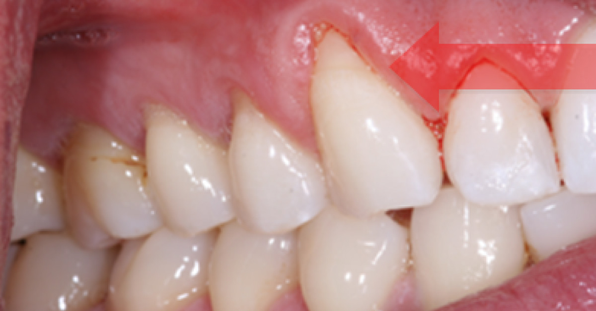 What Is Best Treatment For These Teeth?