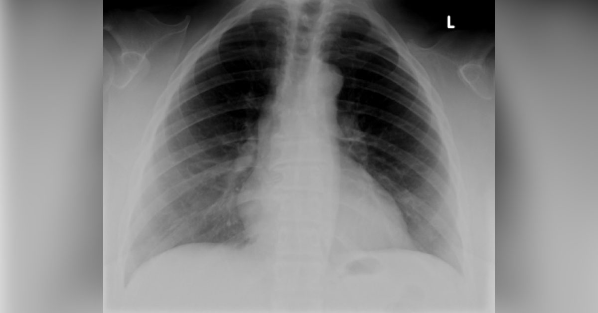 Which Findings Does This Radiograph Suggest