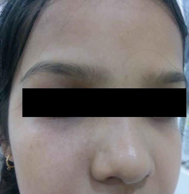 Management Of Hyperpigmented Spots With Paresthesia