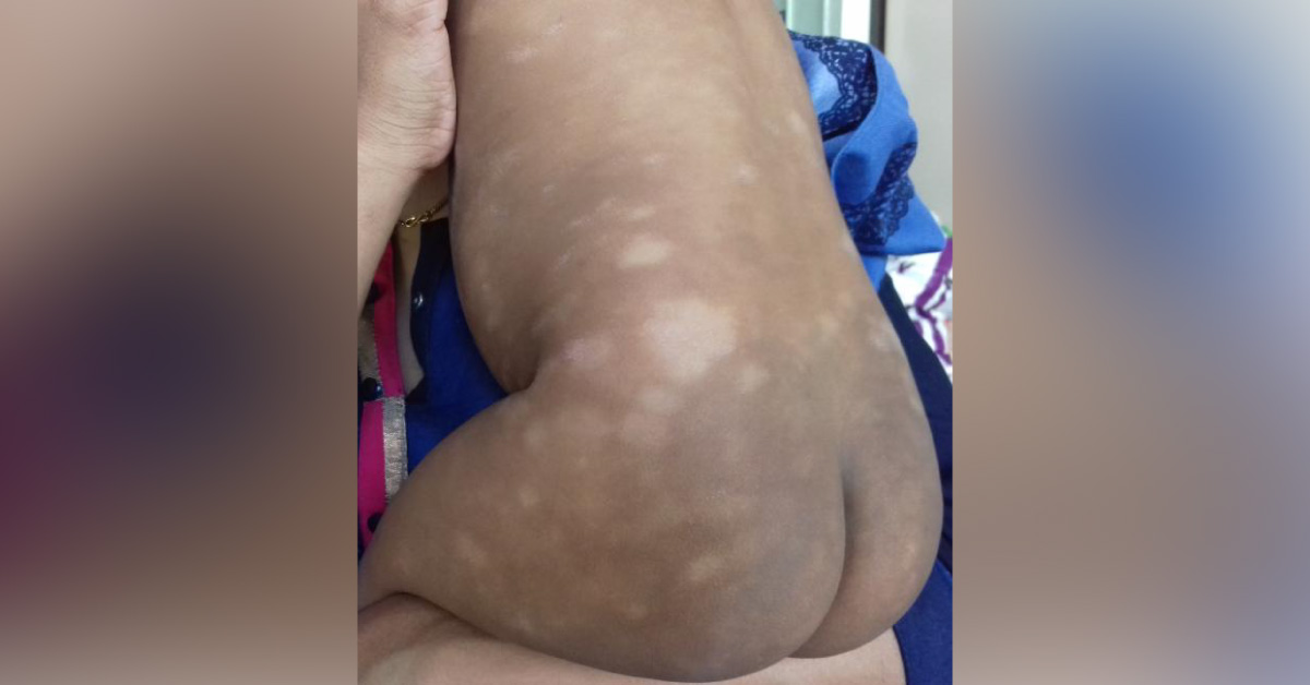 Case Of Wiskott-Aldrich Syndrome And Immunodeficiency