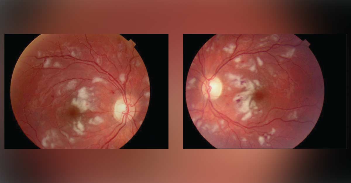 Ocular Manifestations Of Dermatomyositis