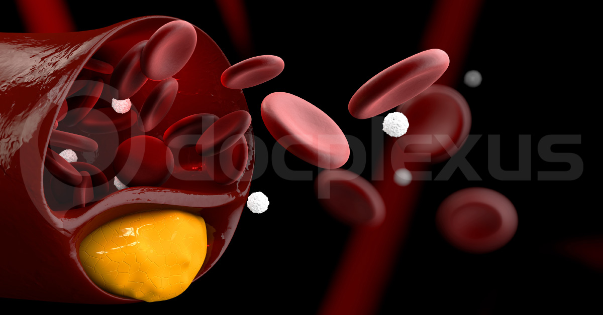 PCSK 9 Inhibitors- A New Treatment Of Hypercholesterolemia