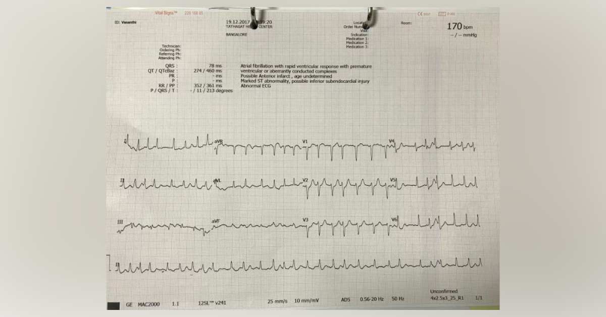 Diabetes Patient Presented With History Of Episodes Of Palpitations