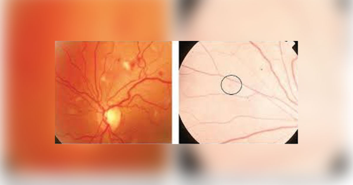 Ocular Manifestations Of Pernicious Anemia
