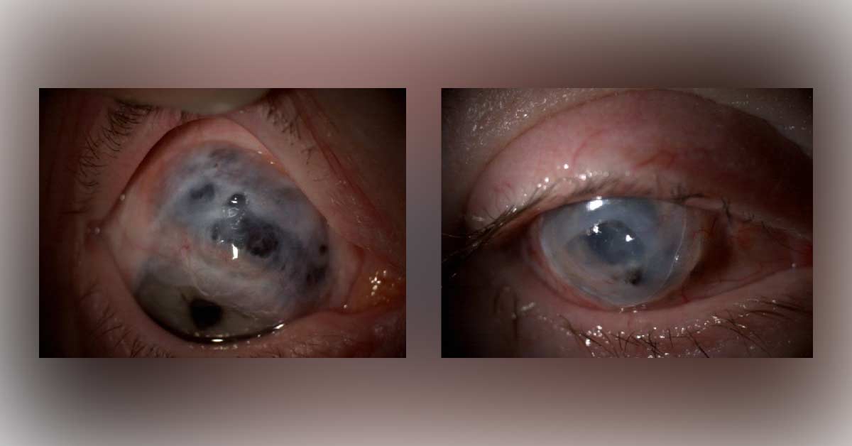Ocular Manifestations Of Scleroderma, A Brief Review