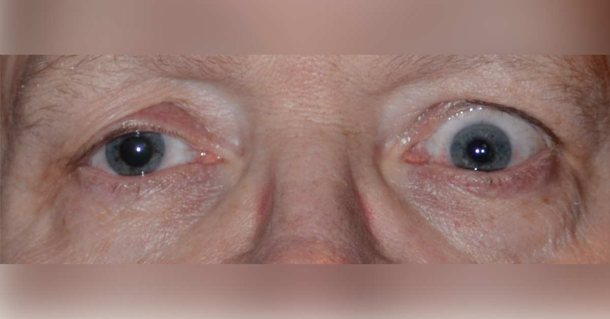 Brief Review On Ocular Manifestations Of Motor Neuron Disease