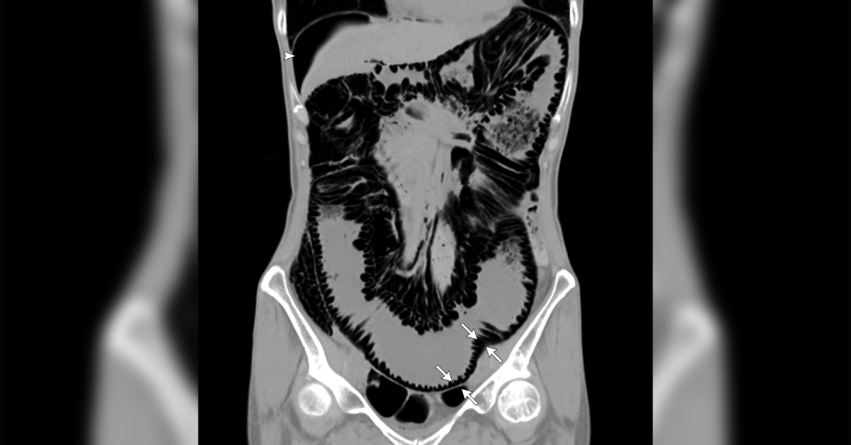 Spot Abnormality From The Attached CT Image