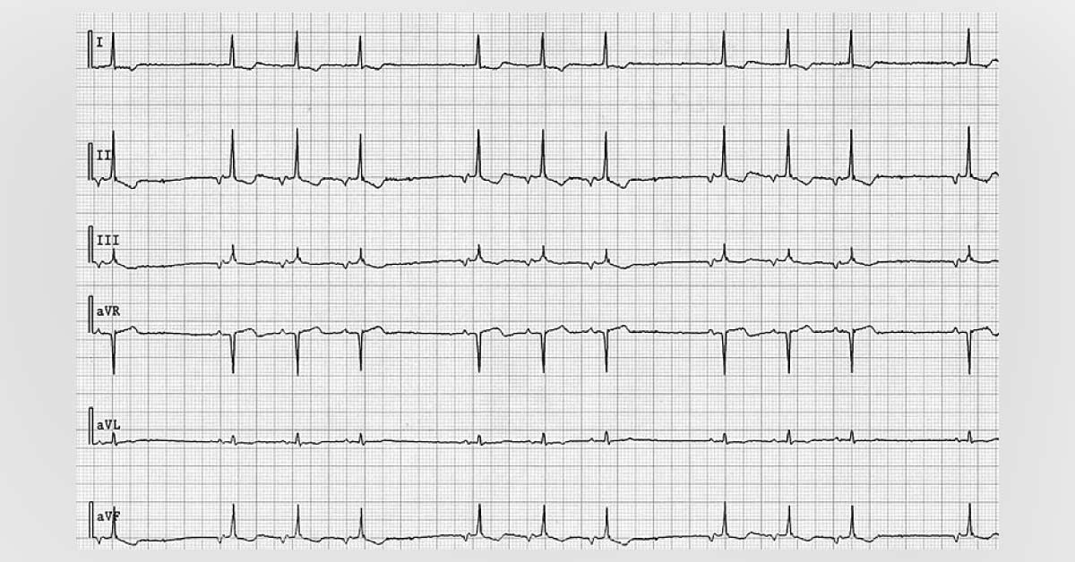 Curious Case Of An Irregular Heart Beat