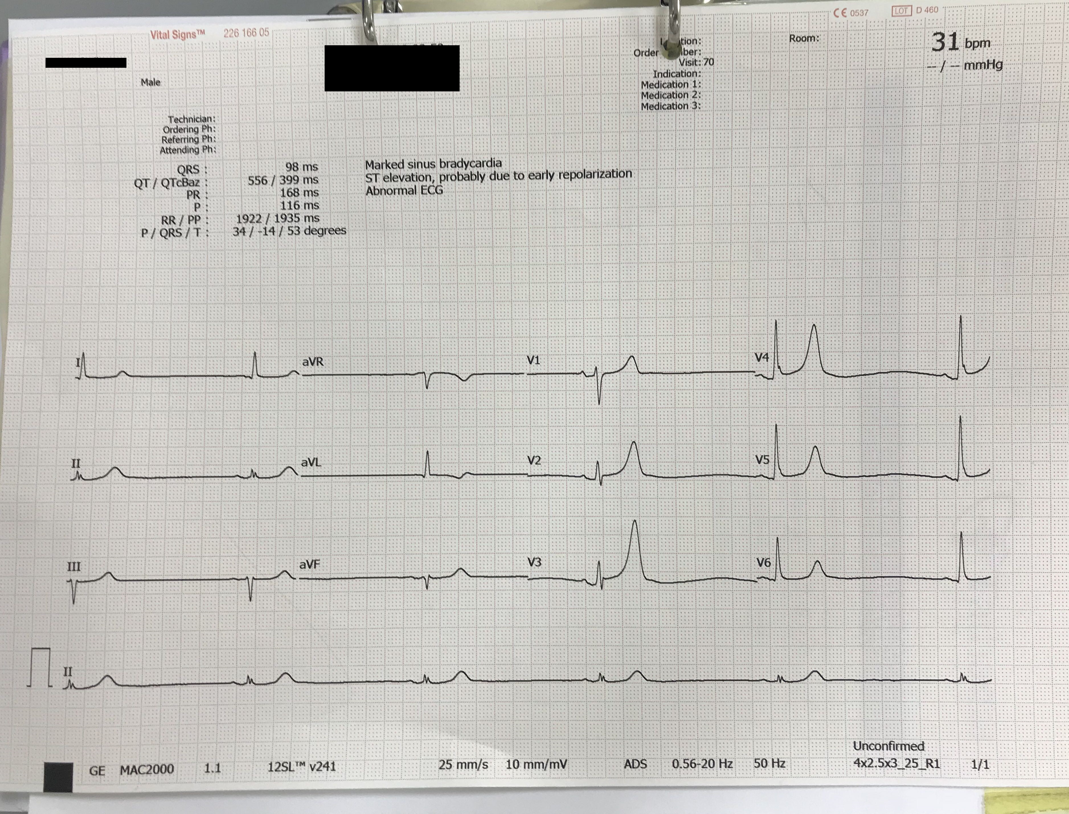73 Years Old Hypertensive, Diabetes Presented With Giddiness Tiredness Mildly Altered Behaviour 