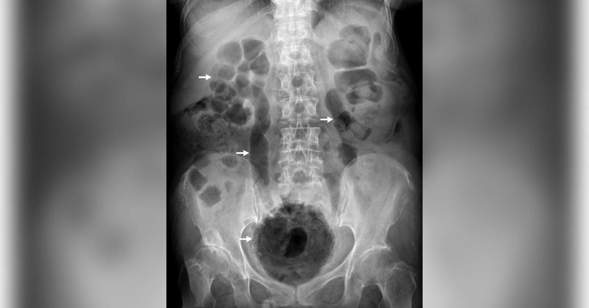 Woman With Lower Abdominal Pain And Dysuria