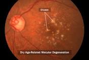 Brief Review Of Age Related Ocular Diseases