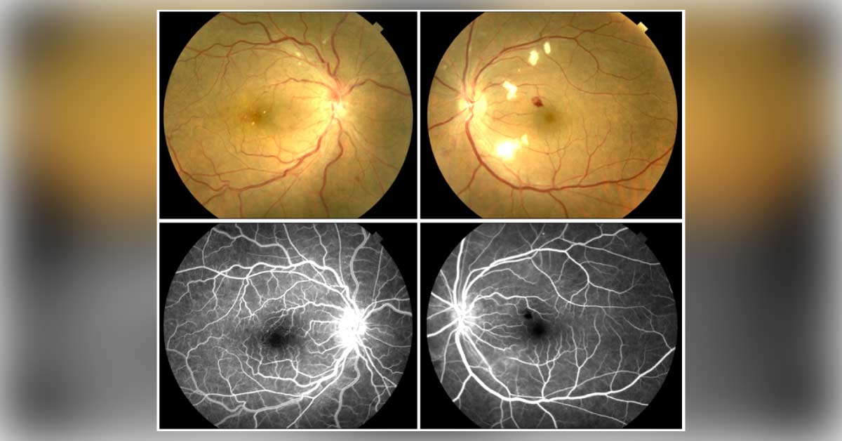 Ocular Manifestations Of Malaria A Brief Review