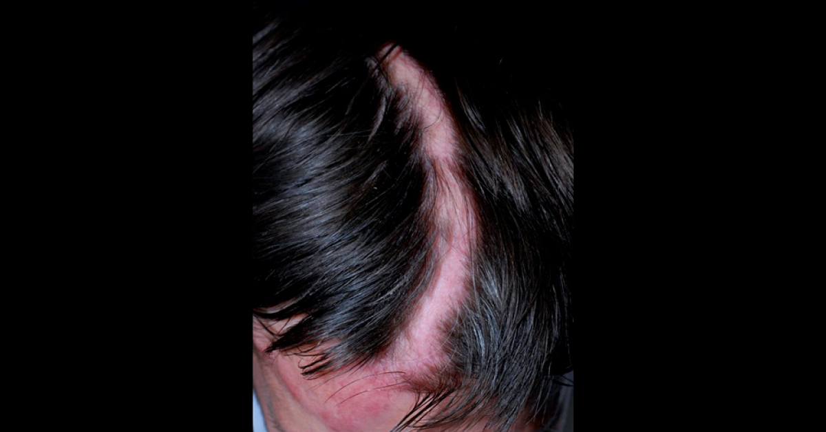 Identify This Balding Disorder