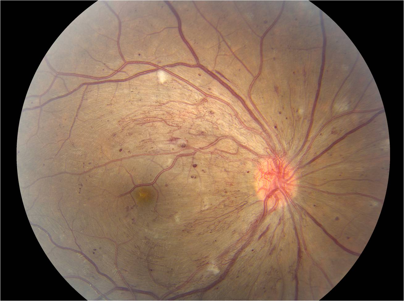 Brief Review On Neovascularization Of Disc