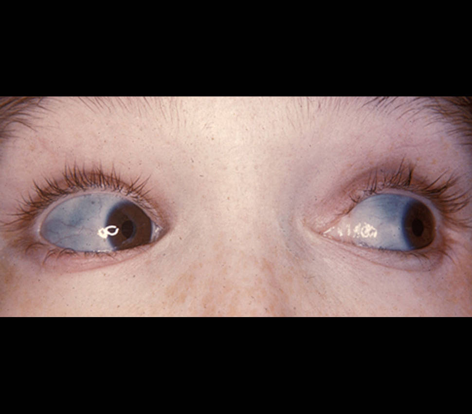 A Brief Review  On Ocular Manifestations Of Osteogenesis Imperfecta