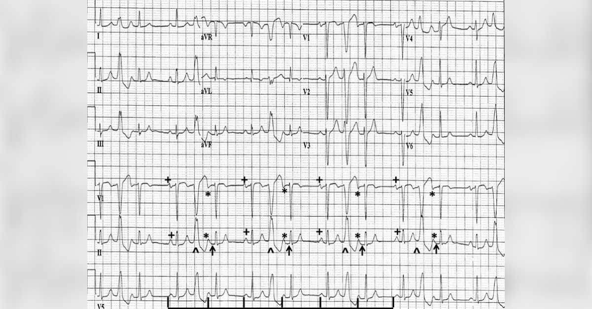 Interpret This ECG