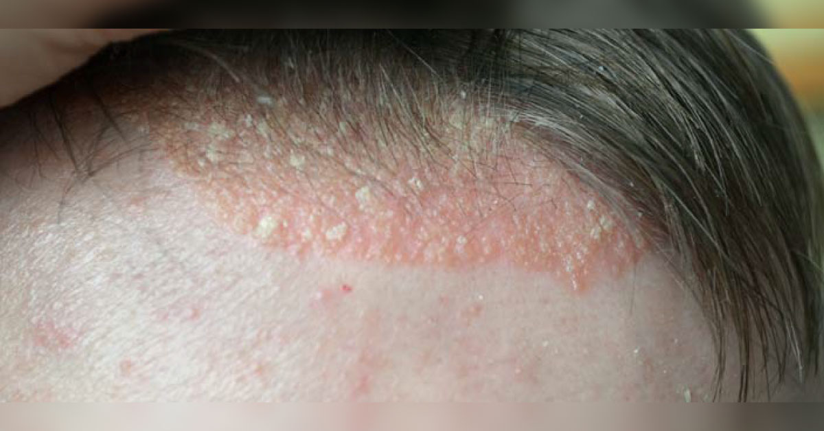 Spot This Dermatological Condition