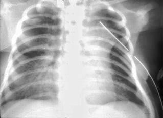 Pulmonary Spot Diagnosis