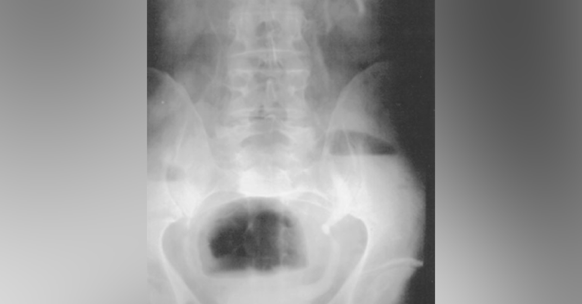 Identify This Urological Disorder