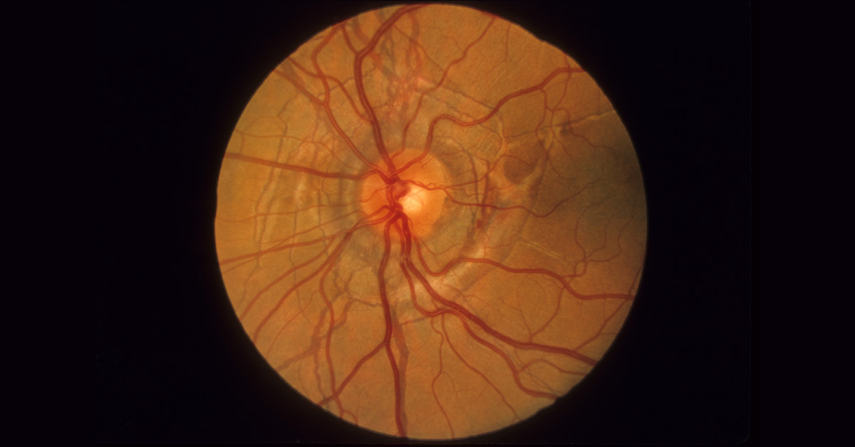 Ocular Manifestations Of Pseudoxanthoma Elasticum
