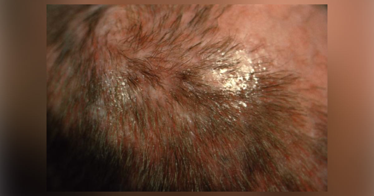 Tinea Capitis Management Guidelines by British Association of Dermatologists