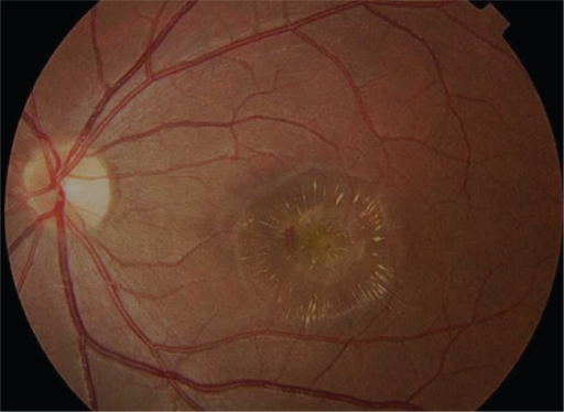 Ocular Conditions Associated With Sub-retinal Neovascularization