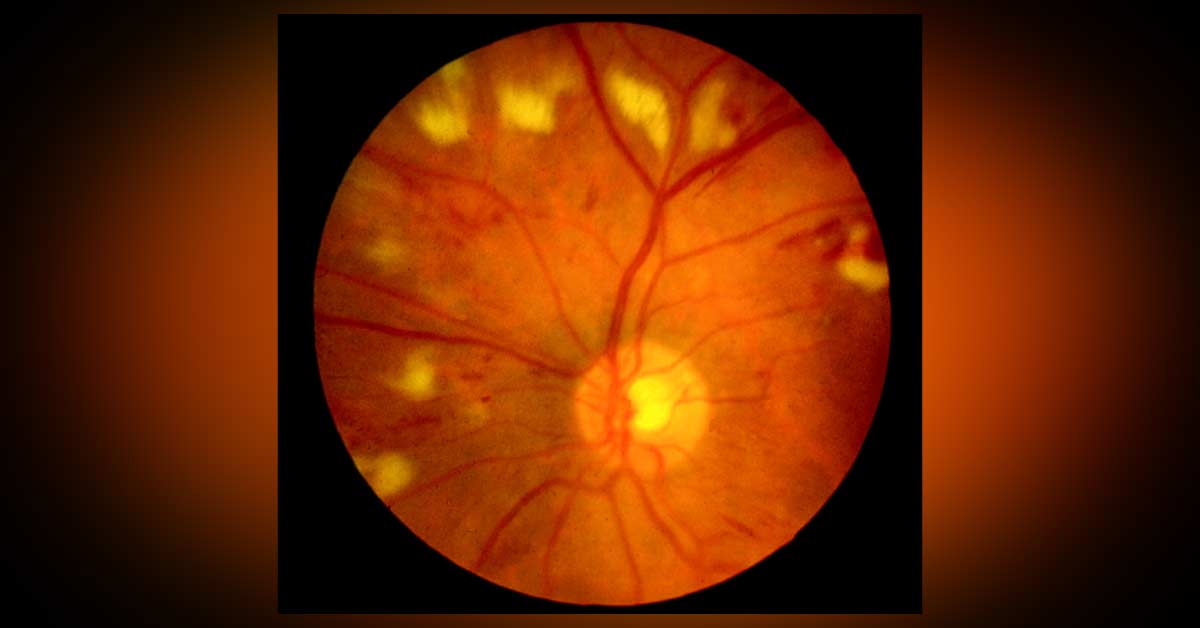 Purtscher's Retinopathy, A Brief Review