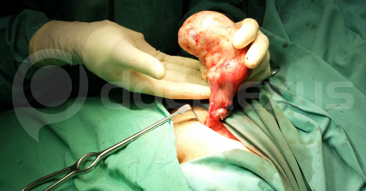 Testicular Cancer,  An Overview