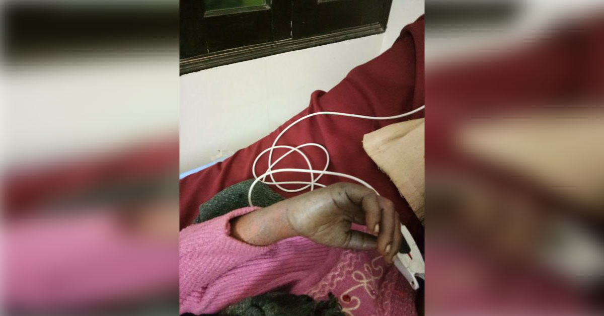 Bluish Discoloration Of Hands And Feet