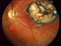 Ocular Manifestations Of Toxoplasmosis A Brief Scenario