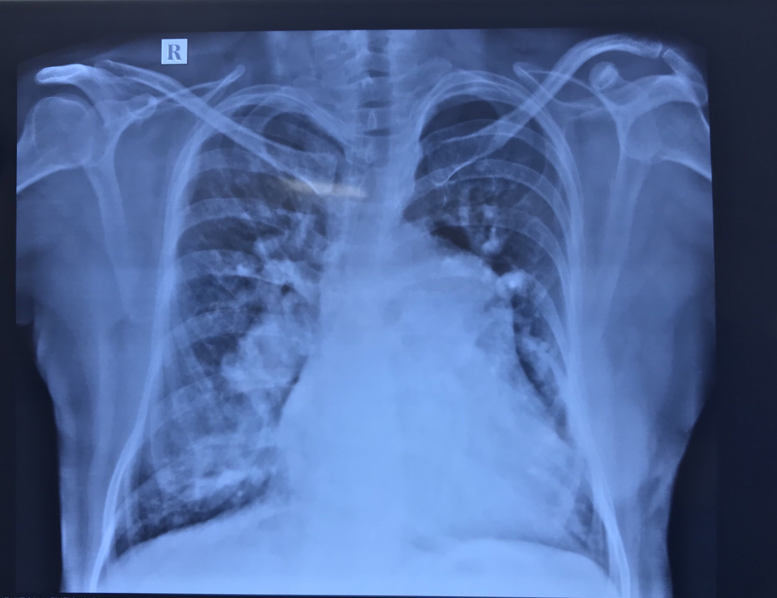 45 Years Old Male Presented With Exertional Breathlessness, Cough, Wheeze 