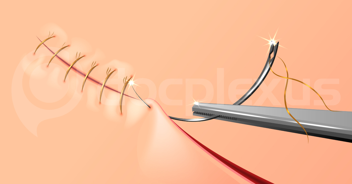 Which Wound Or Cut Sealing Method Provides Maximum Benefit?