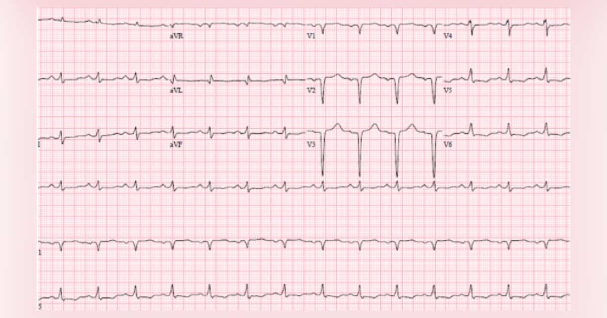 Interesting Cardiology Case