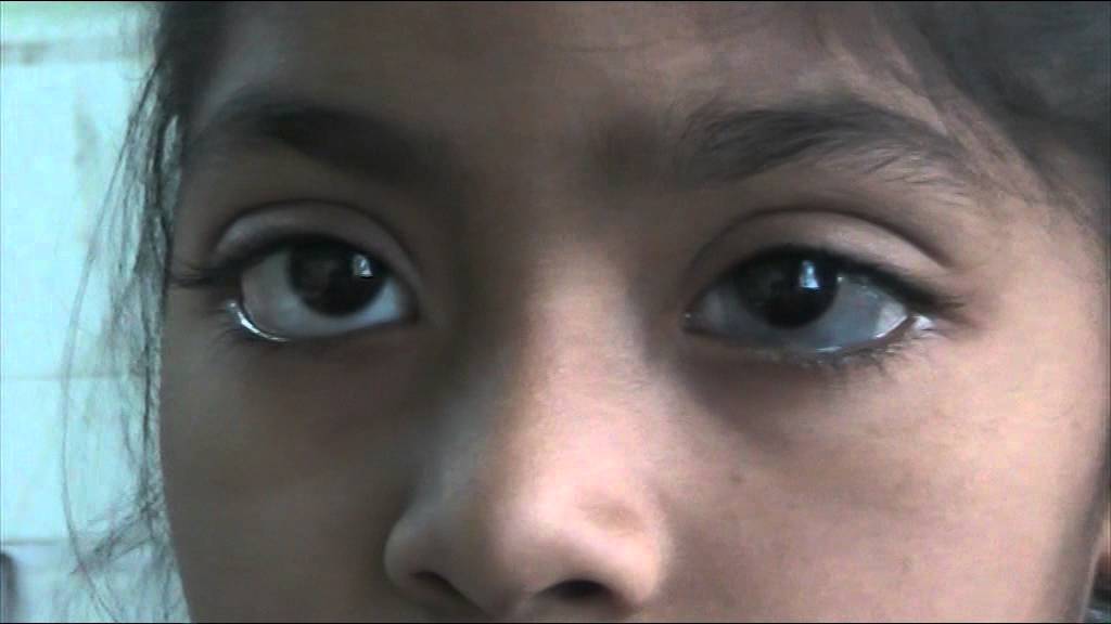 Brief Review On Ocular Manifestations Of Blue Sclera
