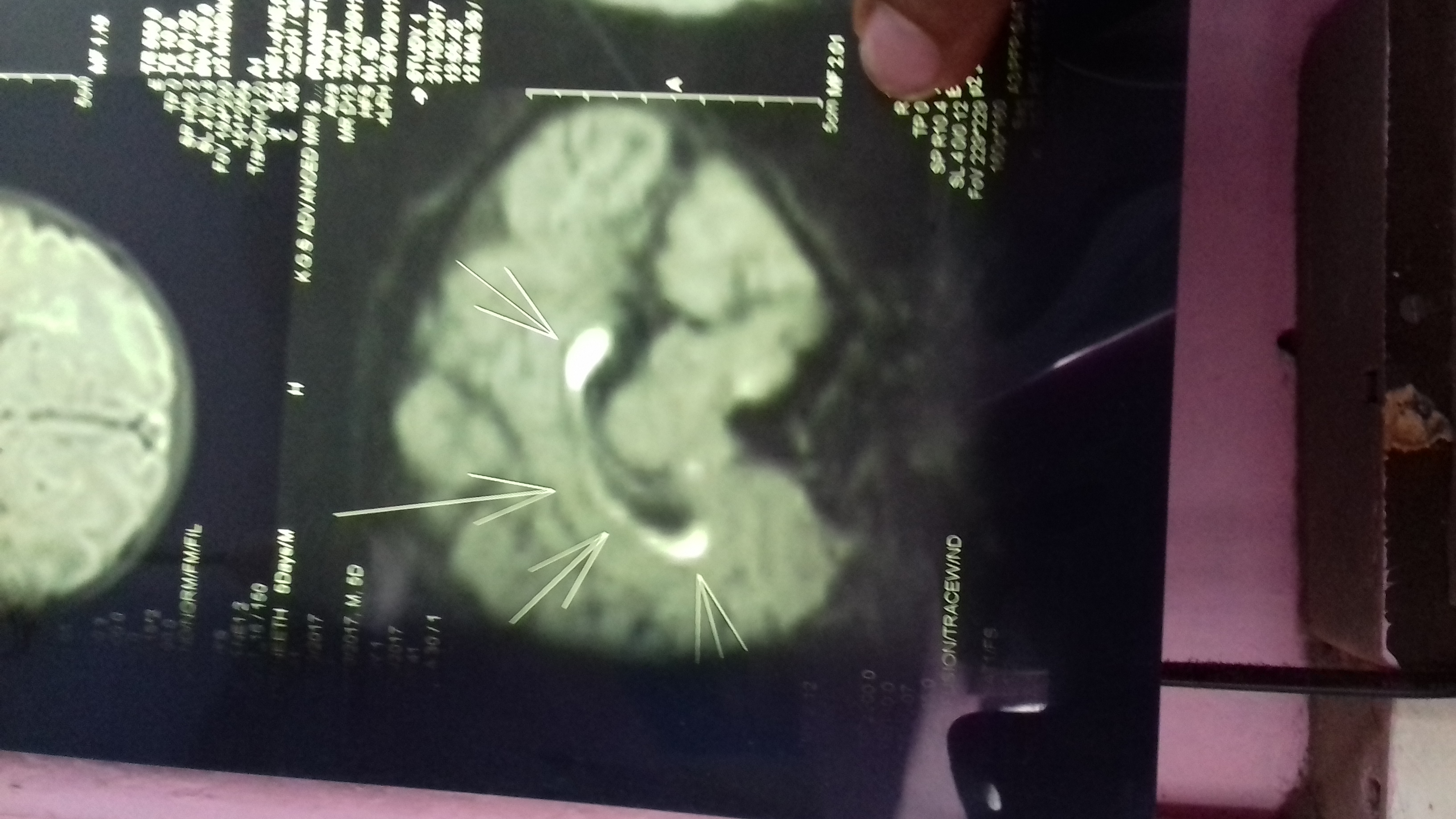 Case Of Neonatal Seizure