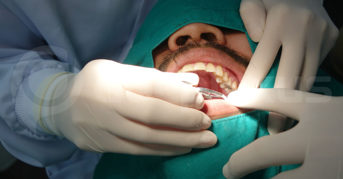 Root Canal In Diabetes: What Are The Precautions?