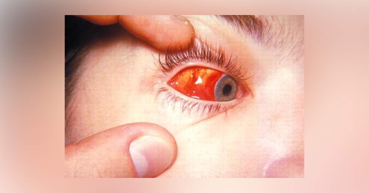 Brief Review On Ocular Manifestations Of Wegeners Granulomatosis