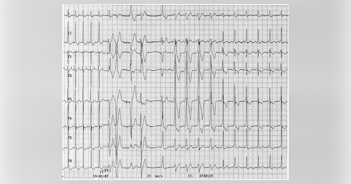 Spot The Underlying Cardiac Abnormality
