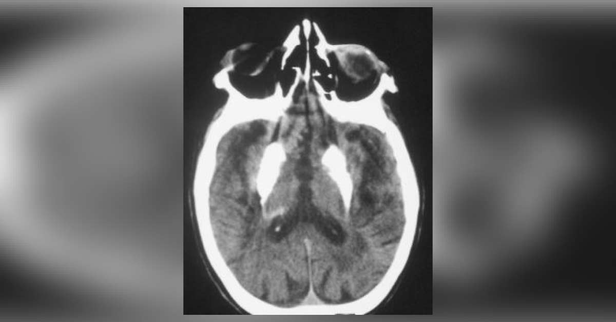 Identify This Neurology Condition