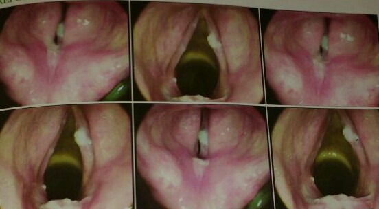 What Is The Provisional Diagnosis And Management Line Of A 55 Yr Old Man With Hoarseness Of Voice?