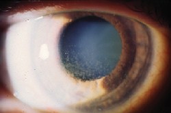 Ocular Manifestations Of Gout A Brief Review