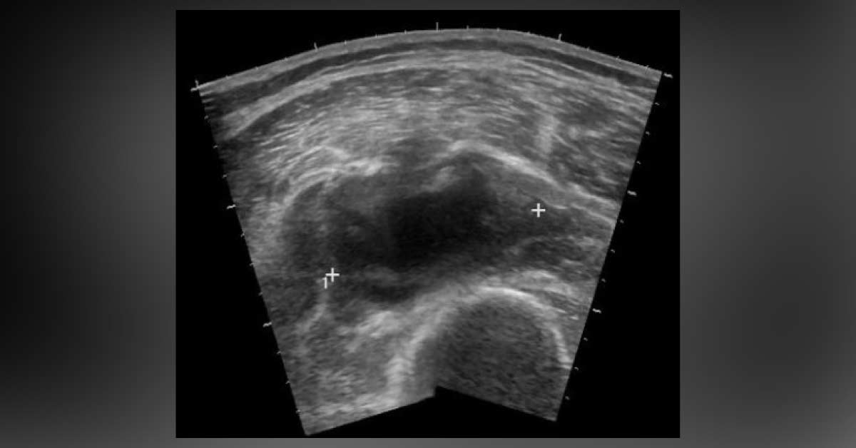 Non-Traumatic Right Thigh Pain, What Can Be The Cause?